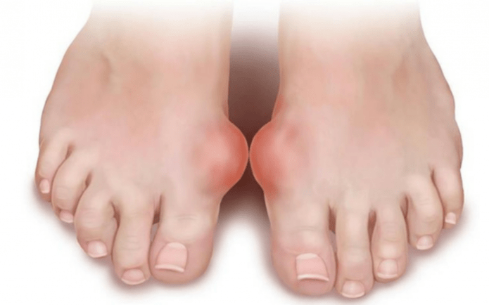 deformacija stopala kot vzrok za pojav glivic na nogah