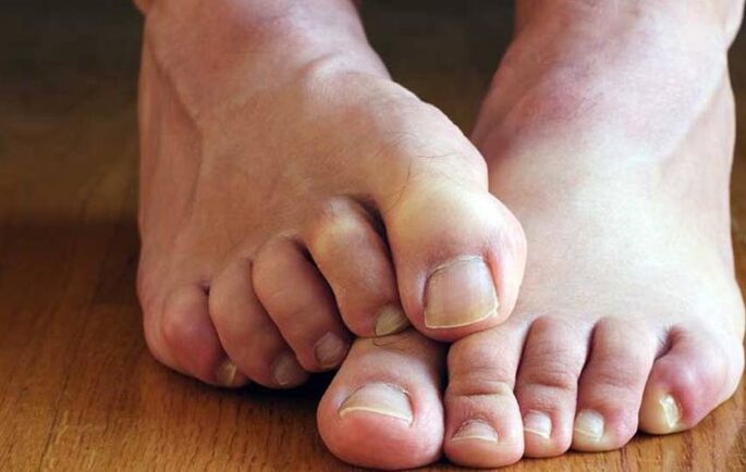 simptomi skvamozne glive na nogah