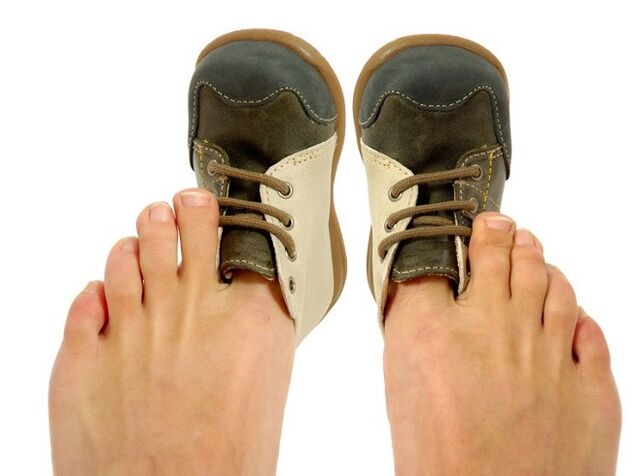 tesni čevlji kot vzrok za glivice med prsti