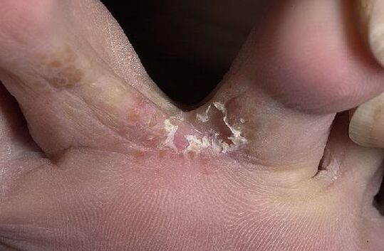 prsti na nogah, ki jih prizadene gliva