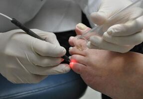 Lasersko zdravljenje glivic na nohtih