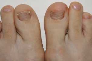 Simptomi stopala glive